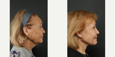 Woman treated with Facelift, Neck Lift - Woman treated with Facelift, Neck Lift