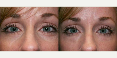 Woman treated with Juvederm to Under Eye - Juvederm to Under Eye