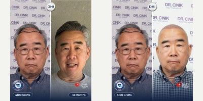 65-74 year old man treated with DHI Hair Transplant, Hair Transplant, Hair Loss Treatment - 4100 grafts 12 months result