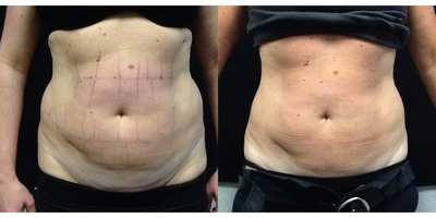 45-54 year old woman treated with CoolSculpting - 45 Year old woman treated with CoolSculpting Abdomen