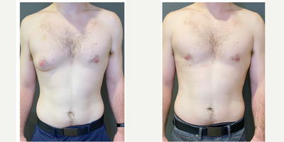 25-34 year old man treated with Gynecomastia Surgery, Breast Reduction - 25 year old man who suffered from one sided gynecomastia underwent right chest liposuction and excision of breast tissue for a masculine, symmetric result. Pictured before and 3 months after. The scar is well hidden around the areola.Ht- 5 10Wt- 175 lbs.