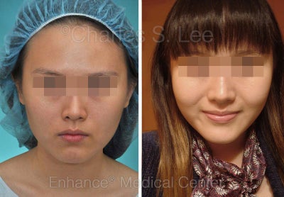 Chin Augmentation, Cheek, Jaw - 	Cheek, Chin and Jaw Narrowing