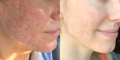 Woman treated with Laser Resurfacing - Woman treated with CO2 Laser Resurfacing, shown 3 weeks post op.