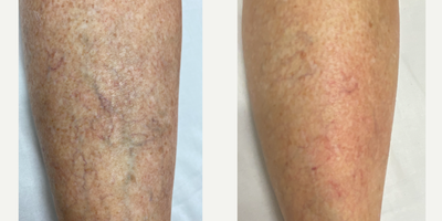 45-54 year old woman treated with Yag Laser - Before and immediately after a YAG vein removal procedure to treat unwanted veins and broken capillaries.
