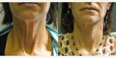 55-64 year old woman treated with TriPollar RF - TriPollar RF treatment for skin tightening on neck