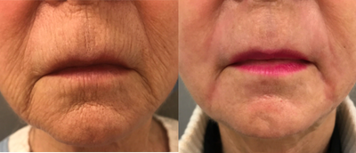 65-74 year old woman treated with Laser Peel - 71 y/o patient treated with peri-oral TRL laser in our office operating suite under sedation.