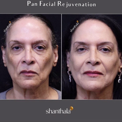 65-74 year old woman treated with Nonsurgical Facelift - Liquid Facelift by Dr. Shanthala