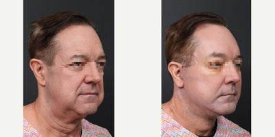 64 year old man treated with Deep Plane Face and Neck Lift, Endolift, Stem Cell Facial Fat Transfer, Submentoplasty, and Lower B - Deep Plane FaceNeck LiftEndoliftStem Cell Facial Fat TransferSubmentoplastyLower Blepharoplasty.