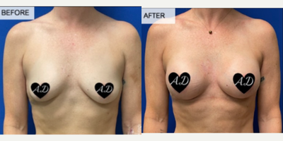 35-44 year old woman treated with Breast Augmentation - My beautiful patient is just 1 month out from a breast augmentation and she looks amazing!