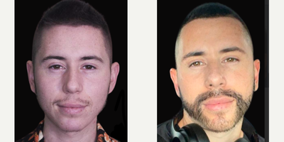 Man treated with Beard Transplant - Bear Transplant