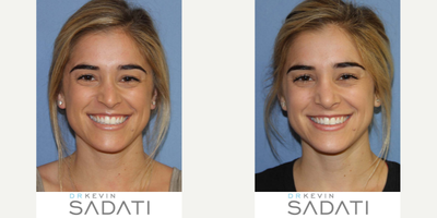 SeptoRhinoplasty procedure on an Orange County Female - SeptoRhinoplasty procedure on an Orange County Female