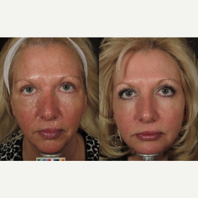 45-54 year old woman treated with Halo Laser - Pt. had a single Halo treatment