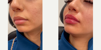 Woman treated with Lip Fillers - Woman treated with Lip Fillers using 1ml of Juvederm XC