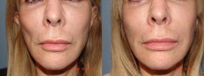 66 year-old female treated for volume loss in cheeks - 
	66 year-old female presents with hollowing of cheek regions. Results shown after one treatment with Sculptra (1 bottle) and prior to second treatment.
