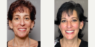 Woman treated with PRF Treatment - Woman treated with PRF Treatment