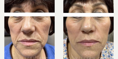 Woman treated with PRF Treatment, Skin Rejuvenation - Woman treated with PRF Treatment, Skin Rejuvenation