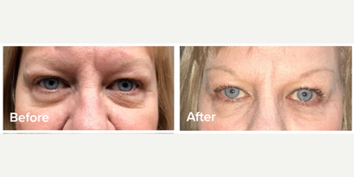 55-64 year old woman treated with Plasma Pen - Now available at The Lifestyle Center in St. Louis, this revolutionary treatment lifts, tightens, and rejuvenates skin non-invasively. Registered with the FDA, the Plasma Pen Ultra Device delivers incredibly natural looking results that last for up to 3 years. Best of all, you can get back to your life even faster with a shorter downtime and recovery!