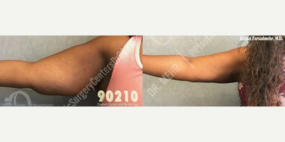 Woman treated with Liposuction - Woman treated with Liposuction to arms