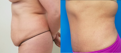45-54 year old woman treated with Tummy Tuck - Abdominoplasty in medium sized woman who had laxity and excess tissues from multiple pregnancies. Results shown area 7 months postoperatively.