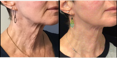 55-64 year old woman treated with Secret RF - 61 year old woman treated with Secret RF/JPlasma/AGNES RF