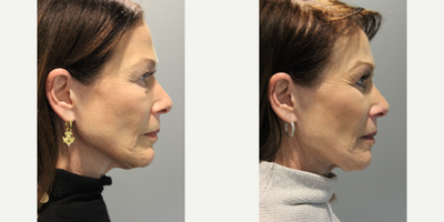 55-64 year old woman treated with Eyelid Surgery - This patient received a right and left lower blepharoplasty.
