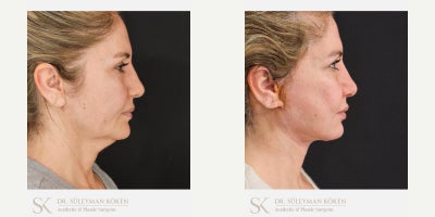 45-54 year old woman treated with Deep Plane Facelift, Chin Liposuction, Facial Fat Transfer - Deep plane full face and neck liftChin LiposuctionNasolabial fat transfer