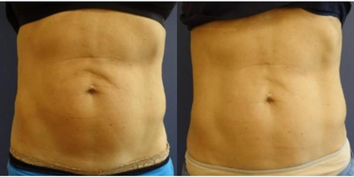 Woman treated with Fractora RF - Woman treated with Fractora RF