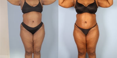 35-44 year old woman treated with Butt Lift - 35-44 year old woman treated with Butt Lift