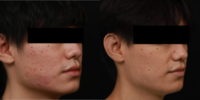 25-34 year old man treated for Acne scarring with a Combination Treatment Approach - Patient was treated with Fraxel re:store (non-ablative laser resurfacing) , Intracel (microneedling with radio frequency) as well as Platelet-Rich Plasma to address acne scarring. Photos show an improvement in textural irregularities and smoother skin.