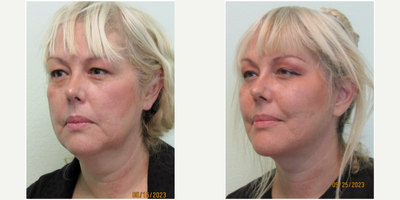50+ year old woman treated with Lower Facelift & Neck Lift - This patient presented with the desire to lessen the heaviness of her lower face and neck. She shared that she had attempted Ultherapy and threads without any significant result, leading her to seek our Center. Her initial exam demonstrated significant jowling in her lower face, along with significant fat in her neck with sagging skin.We agreed upon performing a lower facelift and necklift under local anesthesia in our Center. True procedure time was slightly under 2 hours. Stitches were removed on post-operative days 7 and 12. With her hair down in front of her ears, she looked presentable at day 10 as most of the remaining swelling and bruising were around her ears.