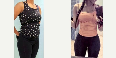 18-24 year old woman treated with Liposuction, Hip Augmentation - 18-24 year old woman treated with Liposuction, Hip Augmentation