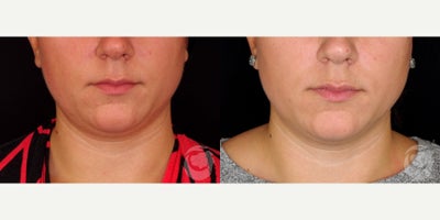 30 year old woman treated with CoolMini to the chin. - 30 year old woman treated with CoolMini to the chin. Photos depict before and 4 months after treatment.