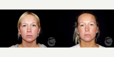 34 year old woman treated with CoolMini to the chin. - 34 year old woman treated with CoolMini to the chin. Photos depict before and 2 months after treatment.