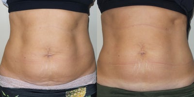 35-44 year old woman treated with Exilis Ultra - 38 year old female treated with Exilis Ultra to Abdomen
