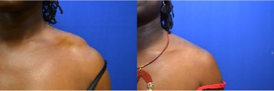 Woman treated with ThermiTight - Woman treated with ThermiTight