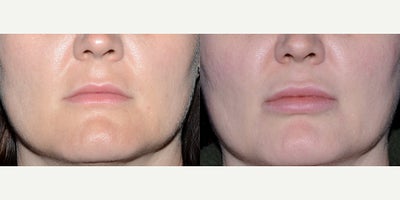32 year old woman treated with Lip Implants. - 32 year old woman treated with Lip Implants.Photos depict before and 2 months after surgery.