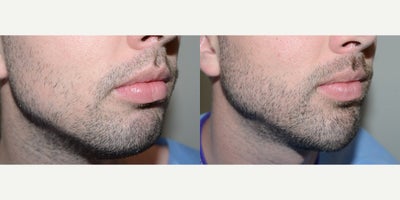 18-24 year old man treated with Beard Transplant - Before and after 1800 FUE grafts to the beard