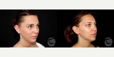 27 year old woman treated with CoolMini to the chin. - 27 year old woman treated with CoolMini to the chin. Photos depict before and 2 months after treatment.