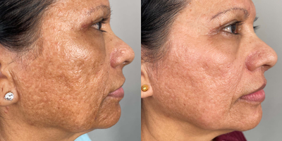 57 year old woman treated with VI Peel - This lovely patient of ours received a VI Peel to treat skin discoloration,