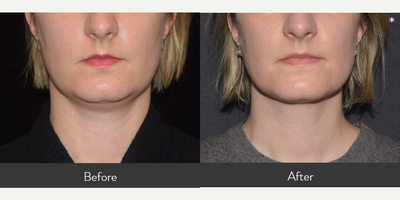 25-34 year old woman treated with CoolSculpting Elite - This 32-year-old female was bothered by her submental fatty tissue. She opted for Coolsculpting Elite and completed 1 round of treatment utilizing two applicators. She is shown before and 2 months after treatment.