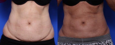 Coolsculpting - Coolsculpting results. 3 months post treatment. Significant fat reduction and skin retraction.