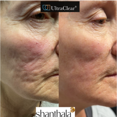 Patient treated with UltraClear Laser - Patient treated with UltraClear Laser