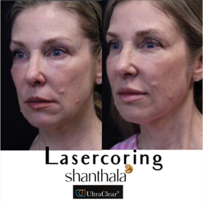 Patient treated with UltraClear Laser - Patient treated with UltraClear Laser