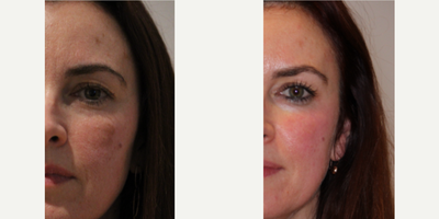 55-64 year old woman treated with Pico Genesis - Before and after photos of client treated with Pico Genesis