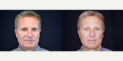 55-64 year old man treated with ArteFill - 56 year old male received 1 syringe of Bellafill to his nasolabial folds; photos depict the patients results 6 months post-treatment.