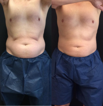 35-44 year old man treated with Venus Legacy - CoolSculpting and Venus Legacy