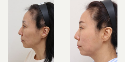 45-54 year old woman treated with Silhouette Soft, AccuLift, Nonsurgical Facelift - 52 Years old female patient Chief Complains: sagging cheeks, under eye bags, uneven face line Treatment plan: - perioral mounds liposuction- silhouette soft thread lift (for middle face area)- full face fat graft- eyelid nano-fat graft- transconjunctival fat repositioning T/C Effect : - smooth face line (temple & cheek hollows was fixed) - face volume restore (forehead, upper cheeks) > more youthful look - flat and smooth eye area- slight lifting effect (lower and middle face part)