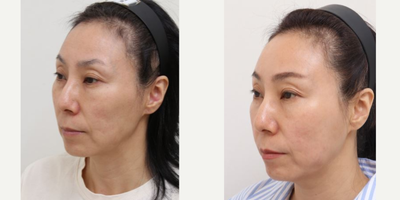 45-54 year old woman treated with Silhouette Soft, AccuLift, Nonsurgical Facelift - 52 Years old female patient Chief Complains: sagging cheeks, under eye bags, uneven face line Treatment plan: - perioral mounds liposuction- silhouette soft thread lift (for middle face area)- full face fat graft- eyelid nano-fat graft- transconjunctival fat repositioning T/C Effect : - smooth face line (temple & cheek hollows was fixed) - face volume restore (forehead, upper cheeks) > more youthful look - flat and smooth eye area- slight lifting effect (lower and middle face part)