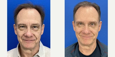 Man treated with Eyelid Surgery, Dysport - Upper and lower blepharoplasty with Dysport on forehead