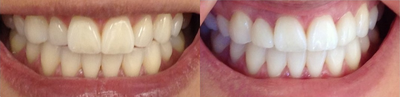 30-39 year old woman treated with Dental Bonding - Patient did not want to do a short course of Invisalign and chose to do 2 veneers, whitening and some contouring to improve her smile.